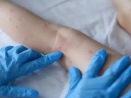 monkeypox
