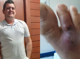 Afastado após picada de aranha-marrom, bombeiro de Joinville pede ajuda para tratamento bombeiro pede ajuda