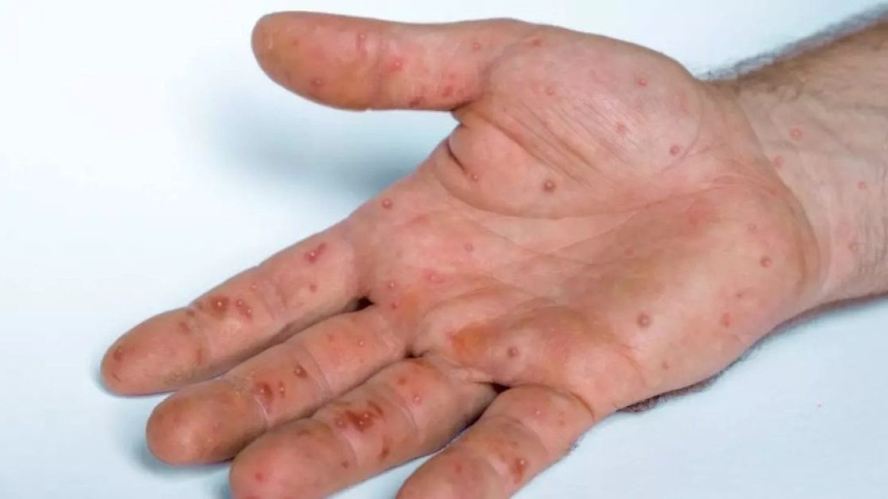 Imagens de Rash hiv sem royalties | DepositPhotos, image size:1280x720