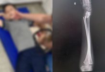 Mãe acusa negligência de escola em Joinville após filho de 9 anos quebrar o braço em aula