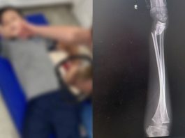 Mãe acusa negligência de escola em Joinville após filho de 9 anos quebrar o braço em aula